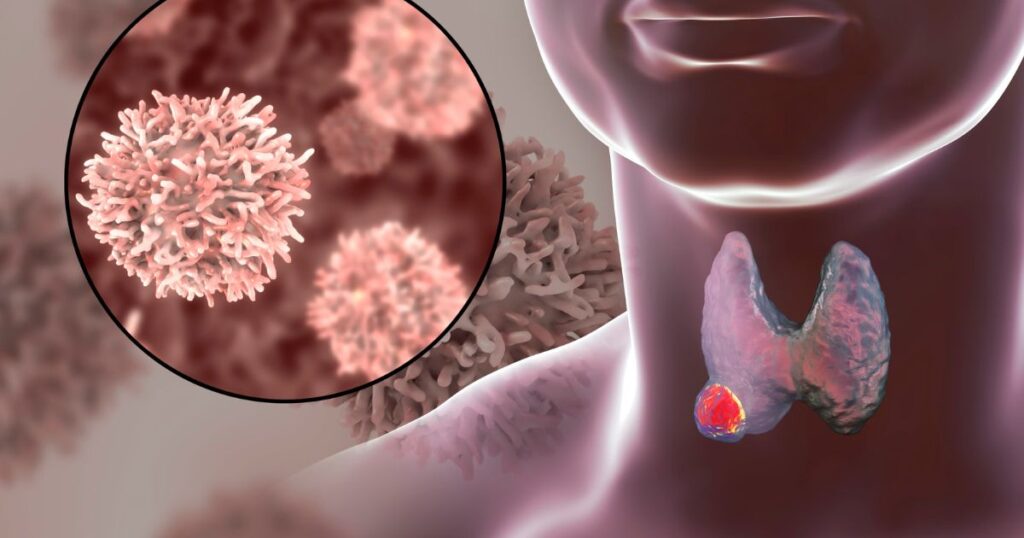 autoimmune diseases of the thyroid gland